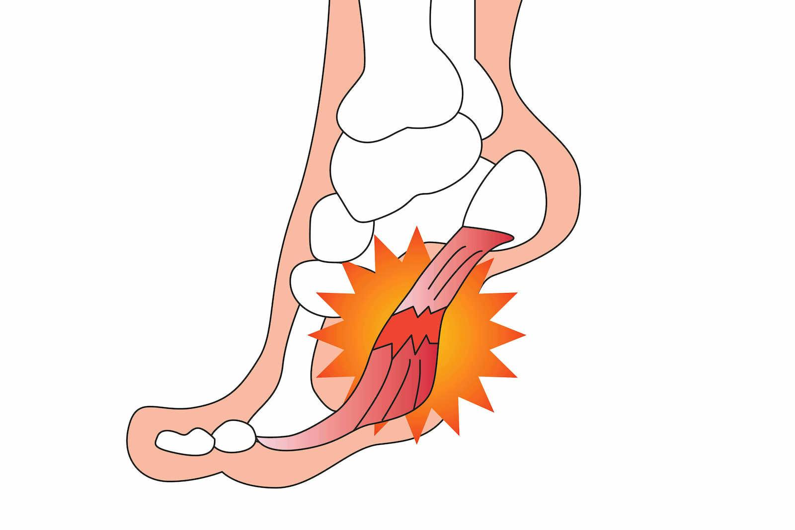 足底筋膜炎とは。チェック方法、原因、治し方、改善トレーニングを紹介