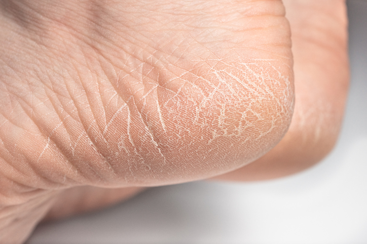 足の裏の角質ケア方法とは？原因や除去方法についても解説
